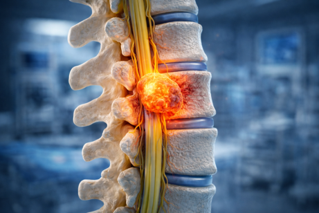 Spinal Tumor
